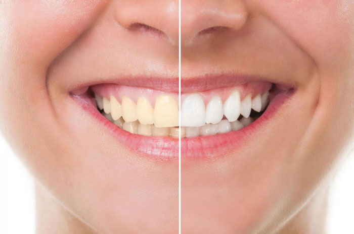 differeence between women's teeth